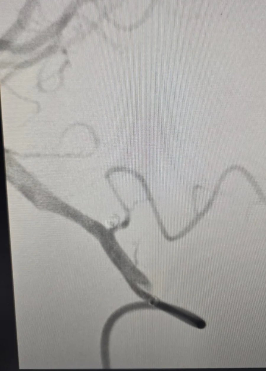 PICA aneurysm angiography supplied as final view