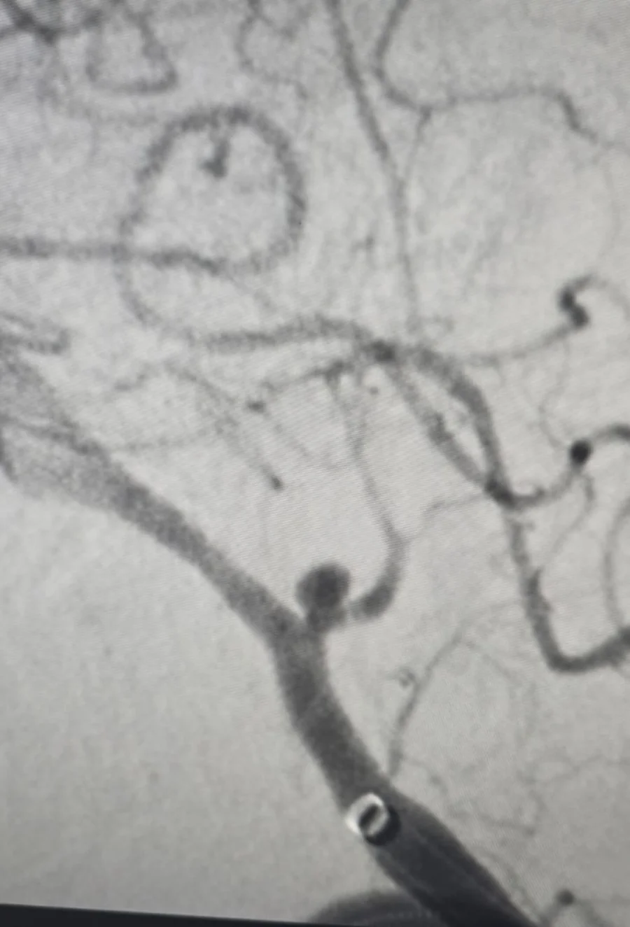 PICA aneurysm angiogram supplied as first image