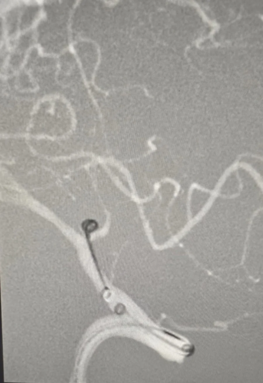 PICA aneurysm angiography with catheter and coil system