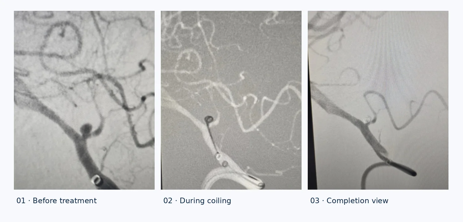 Three original angiographic views of PICA aneurysm treatment